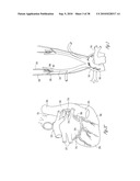 ADAPTIVE BAROREFLEX STIMULATION THERAPY FOR DISORDERED BREATHING diagram and image