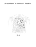 ADAPTIVE BAROREFLEX STIMULATION THERAPY FOR DISORDERED BREATHING diagram and image