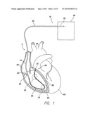 LEAD CONFIGURED FOR HISIAN, PARA-HISIAN, RV SEPTUM AND RV OUTFLOW TRACT PACING diagram and image