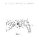 GLENOID IMPLANT ANCHOR POST diagram and image