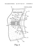 GLENOID IMPLANT ANCHOR POST diagram and image