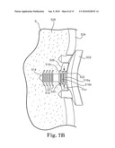 GLENOID IMPLANT ANCHOR POST diagram and image