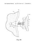 GLENOID IMPLANT ANCHOR POST diagram and image