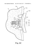 GLENOID IMPLANT ANCHOR POST diagram and image