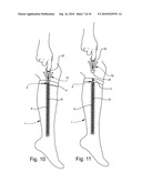 DEVICE FOR OPENING AND CLOSING A ZIPPER diagram and image