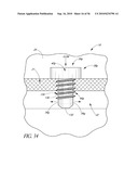 OCULAR IMPLANT WITH THERAPEUTIC AGENTS AND METHODS THEREOF diagram and image