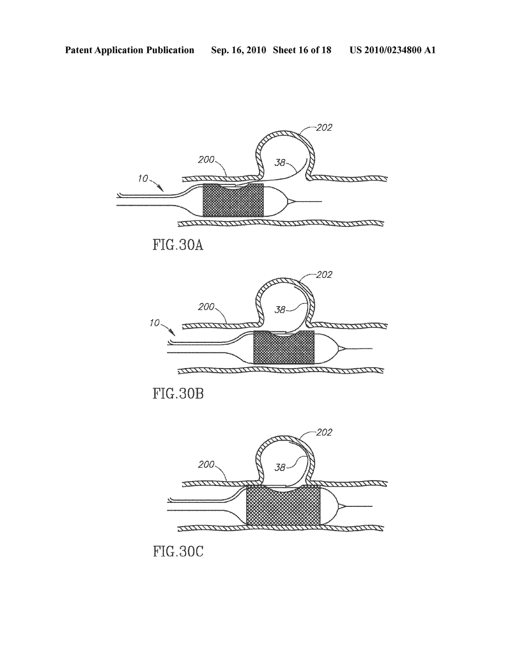 VESSEL TREATMENT DEVICES - diagram, schematic, and image 17