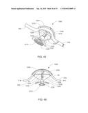 Devices and Methods For Occluding a Flexible Tube diagram and image