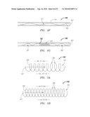 Systems and Methods for Treating Septal Defects diagram and image