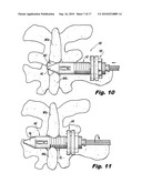 Interspinous Process Implant and Fusion Cage Spacer diagram and image