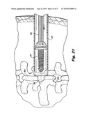 Interspinous Process Implant and Fusion Cage Spacer diagram and image