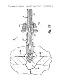 Interspinous Process Implant and Fusion Cage Spacer diagram and image