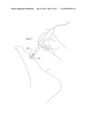 TREATMENT OF MICROBIOLOGICAL PATHOGENS IN A TOE NAIL WITH ANTIMICROBIAL LIGHT diagram and image