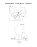 TREATMENT OF MICROBIOLOGICAL PATHOGENS IN A TOE NAIL WITH ANTIMICROBIAL LIGHT diagram and image