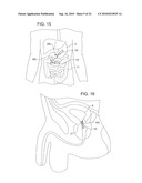 TREATMENT OF MICROBIOLOGICAL PATHOGENS IN A TOE NAIL WITH ANTIMICROBIAL LIGHT diagram and image