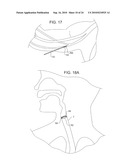 TREATMENT OF MICROBIOLOGICAL PATHOGENS IN A TOE NAIL WITH ANTIMICROBIAL LIGHT diagram and image