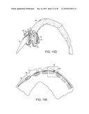 SYSTEM AND METHOD FOR DEPLOYING AN ENDOLUMINAL PROSTHESIS AT A SURGICAL SITE diagram and image