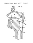 IMPLANT SYSTEMS AND METHODS FOR TREATING OBSTRUCTIVE SLEEP APNEA diagram and image