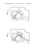 IMPLANT SYSTEMS AND METHODS FOR TREATING OBSTRUCTIVE SLEEP APNEA diagram and image