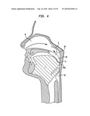 IMPLANT SYSTEMS AND METHODS FOR TREATING OBSTRUCTIVE SLEEP APNEA diagram and image