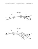 IMPLANT SYSTEMS AND METHODS FOR TREATING OBSTRUCTIVE SLEEP APNEA diagram and image