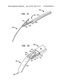 IMPLANT SYSTEMS AND METHODS FOR TREATING OBSTRUCTIVE SLEEP APNEA diagram and image