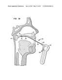 IMPLANT SYSTEMS AND METHODS FOR TREATING OBSTRUCTIVE SLEEP APNEA diagram and image