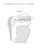 IMPLANT SYSTEMS AND METHODS FOR TREATING OBSTRUCTIVE SLEEP APNEA diagram and image