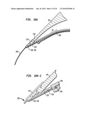 IMPLANT SYSTEMS AND METHODS FOR TREATING OBSTRUCTIVE SLEEP APNEA diagram and image