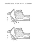 IMPLANT SYSTEMS AND METHODS FOR TREATING OBSTRUCTIVE SLEEP APNEA diagram and image