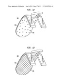 IMPLANT SYSTEMS AND METHODS FOR TREATING OBSTRUCTIVE SLEEP APNEA diagram and image