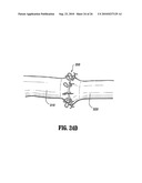 End-To-End Anastomosis Instrument and Method for Performing Same diagram and image