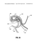 End-To-End Anastomosis Instrument and Method for Performing Same diagram and image