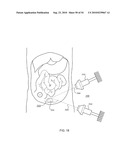 ORTHOVOLTAGE RADIOSURGERY diagram and image