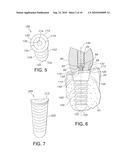 ASYMMETRICAL DENTAL IMPLANT AND METHOD OF INSERTION diagram and image