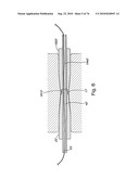 DEVICES FOR MINIMALLY INVASIVE PELVIC SURGERY diagram and image