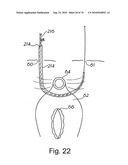 DEVICES FOR MINIMALLY INVASIVE PELVIC SURGERY diagram and image