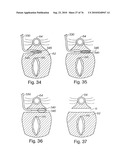 DEVICES FOR MINIMALLY INVASIVE PELVIC SURGERY diagram and image