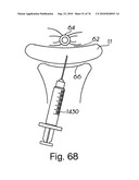 DEVICES FOR MINIMALLY INVASIVE PELVIC SURGERY diagram and image