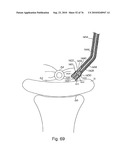 DEVICES FOR MINIMALLY INVASIVE PELVIC SURGERY diagram and image