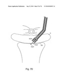 DEVICES FOR MINIMALLY INVASIVE PELVIC SURGERY diagram and image