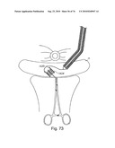 DEVICES FOR MINIMALLY INVASIVE PELVIC SURGERY diagram and image