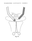 DEVICES FOR MINIMALLY INVASIVE PELVIC SURGERY diagram and image