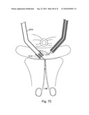 DEVICES FOR MINIMALLY INVASIVE PELVIC SURGERY diagram and image