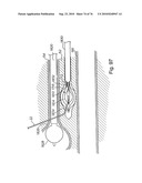 DEVICES FOR MINIMALLY INVASIVE PELVIC SURGERY diagram and image