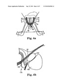 MALE URETHRAL PROSTHESIS WITH TENSIONING MEMBER diagram and image