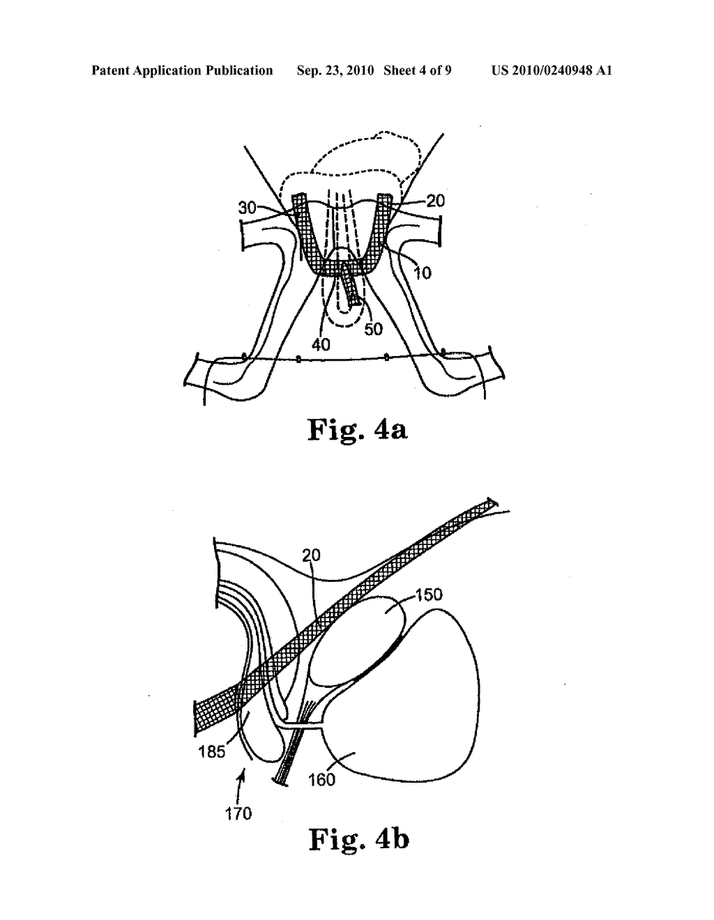 MALE URETHRAL PROSTHESIS WITH TENSIONING MEMBER - diagram, schematic, and image 05