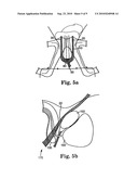 MALE URETHRAL PROSTHESIS WITH TENSIONING MEMBER diagram and image