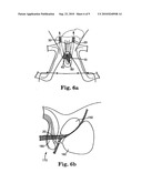 MALE URETHRAL PROSTHESIS WITH TENSIONING MEMBER diagram and image