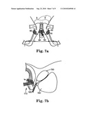 MALE URETHRAL PROSTHESIS WITH TENSIONING MEMBER diagram and image